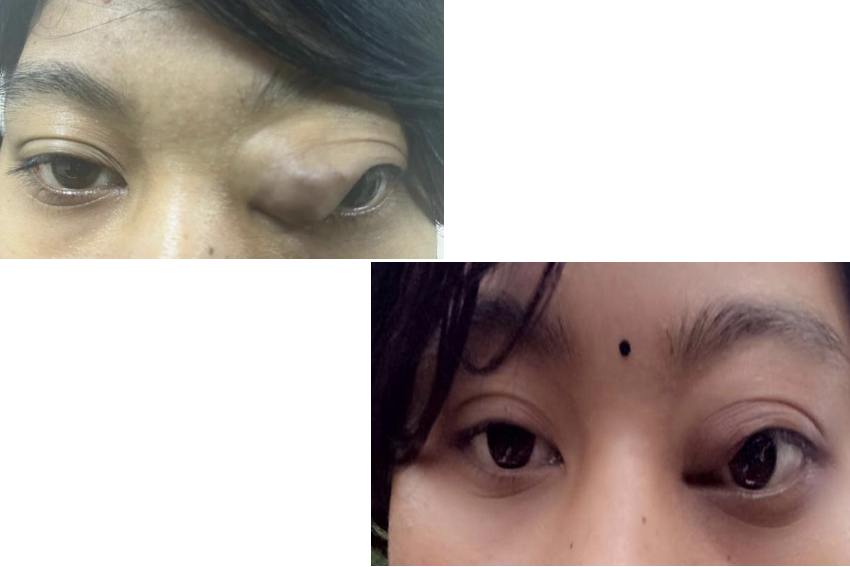 Orbital and Pre Septal AVM which was embolised successfully by Interventional Radiologist of GMCH. Patient improved significantly after the treatment with intact vision